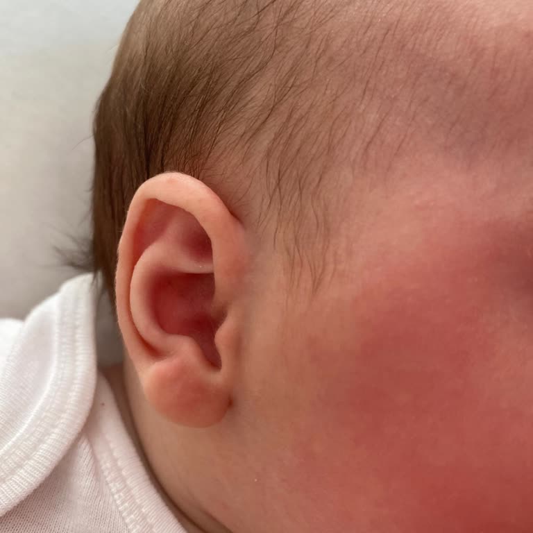 Islak Mendil Cilt Tahrişine Sebep Oldu