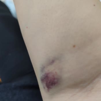 Tecrübesiz Hemşire Nedeniyle Kolum Morardı