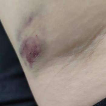 Tecrübesiz Hemşire Nedeniyle Kolum Morardı