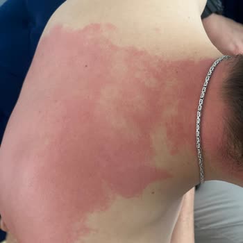 Thermoflex Kremi İle Ciltte Kızarıklık Ve Yanma Sorunu