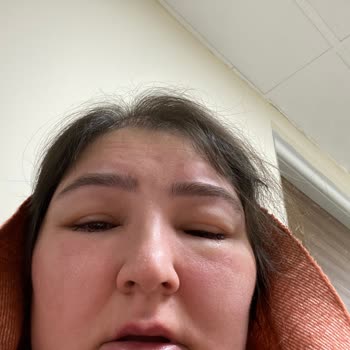 Nivea Krem Sonrası Yüzde Alerjik Reaksiyon Ve Seyahat İptali