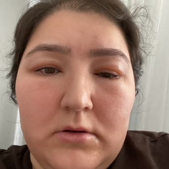 Nivea Krem Sonrası Yüzde Alerjik Reaksiyon Ve Seyahat İptali