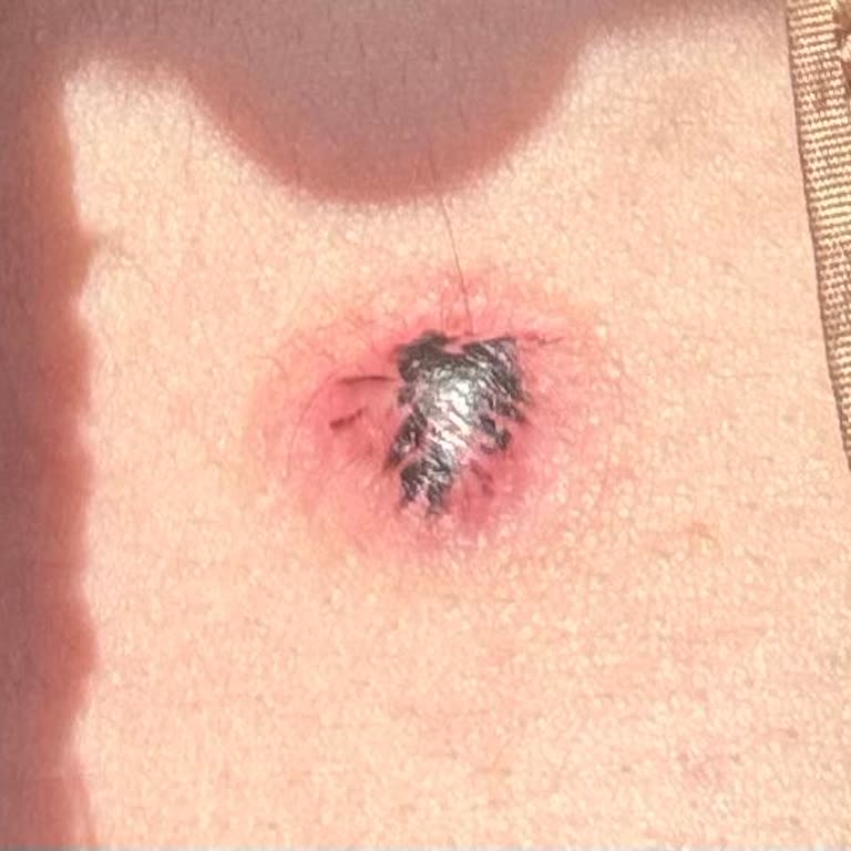 Lazerle Ben Tedavisi Fiyaskosu: Hem Para Gitti Hem Şişlik Kaldı