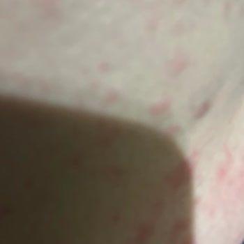 Ozmo Yumurta Kafalar Alerji Şikayeti: Acil Çözüm Bekleniyor