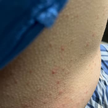 Ozmo Yumurta Kafalar Alerji Şikayeti: Acil Çözüm Bekleniyor