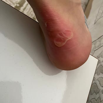 Adidas Superstar Wunden und Abnutzung an der Ferse nach dem Tragen, schlechte Qualität