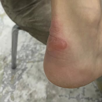 Adidas Superstar Wunden und Abnutzung an der Ferse nach dem Tragen, schlechte Qualität