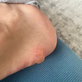 Adidas Superstar Wunden und Abnutzung an der Ferse nach dem Tragen, schlechte Qualität