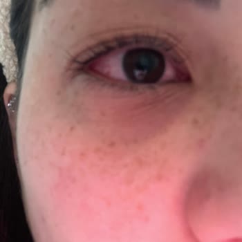 Kirpik Lifting Sonrası Gözümde Şişlik Ve Akıntı