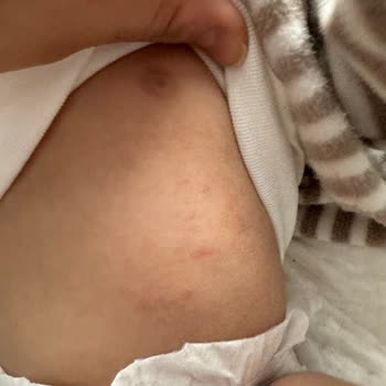 Mustela Bebek Ürünleri Cilt Sorunlarına Yol Açtı