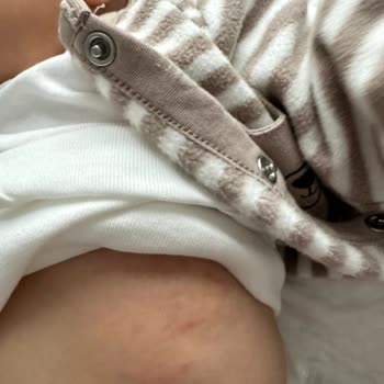 Mustela Bebek Ürünleri Cilt Sorunlarına Yol Açtı