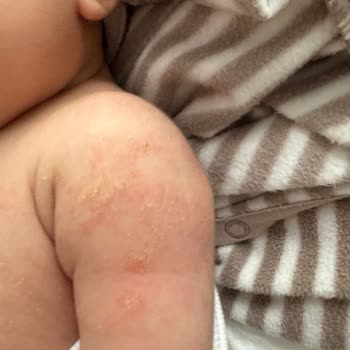 Mustela Bebek Ürünleri Cilt Sorunlarına Yol Açtı