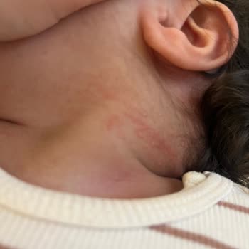 Mustela Bebek Losyonu Cilt Reaksiyonu Yarattı