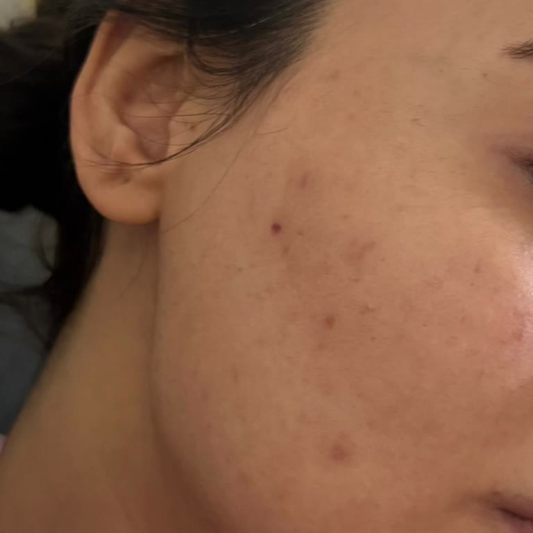 Lazer İşleminden Memnuniyetsizlik Ve Ekstra Paket Baskısı