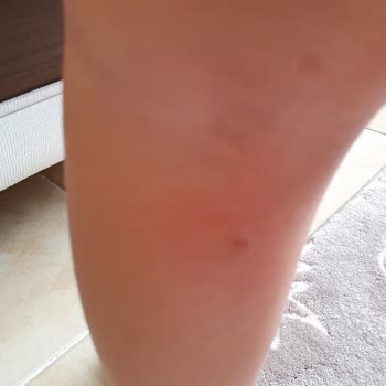 Bioderma Ürünleri Çocuklarda Alerjik Reaksiyon Yarattı