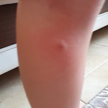 Bioderma Ürünleri Çocuklarda Alerjik Reaksiyon Yarattı