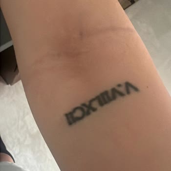 Dövme Sildirme İşlemi Hüsranla Sonuçlandı