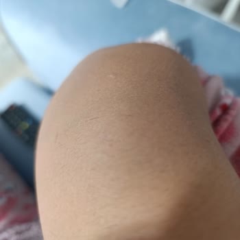 Lazer Epilasyon Hüsranı: Boş Vaatler Ve Sonuçsuz Seanslar