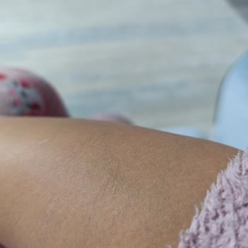 Lazer Epilasyon Hüsranı: Boş Vaatler Ve Sonuçsuz Seanslar