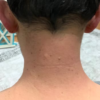 Thermoflex Krem Ciltte Yanma Ve Kızarıklığa Sebep Oluyor!