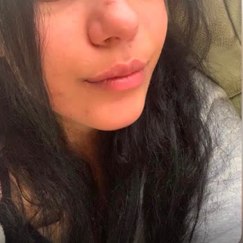 Cildiye Tedavisi Sonrası Artan İzler Ve Çözüm Beklentisi