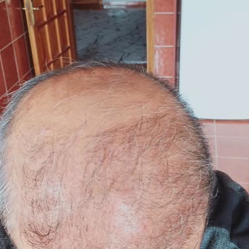 Gökhan Turanlıoğlu Güzellik Merkezi Kötü Saç Ekimi