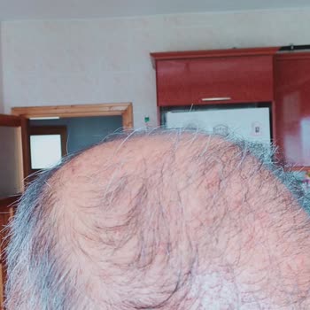 Gökhan Turanlıoğlu Güzellik Merkezi Kötü Saç Ekimi