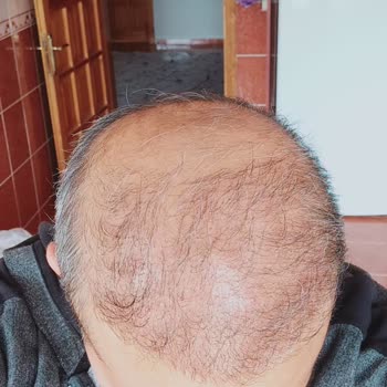 Gökhan Turanlıoğlu Güzellik Merkezi Kötü Saç Ekimi