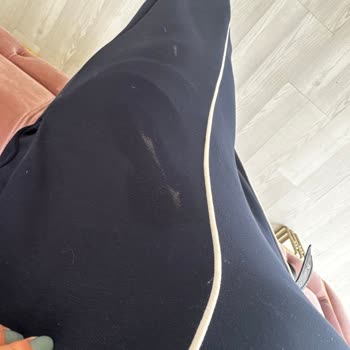 Lazer Seansı Sonrası Yanık Lekeleri Ve İlgisiz Hizmet