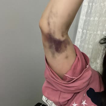 Palmiye Hastanesi Yanlış İğne Kullanımı Ve İlgisiz Hemşir Sorunu