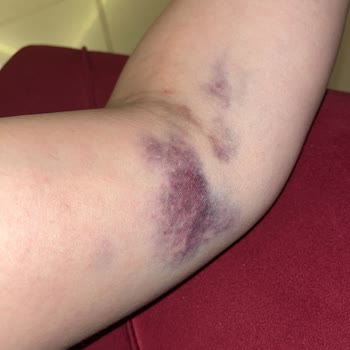 Palmiye Hastanesi Yanlış İğne Kullanımı Ve İlgisiz Hemşir Sorunu