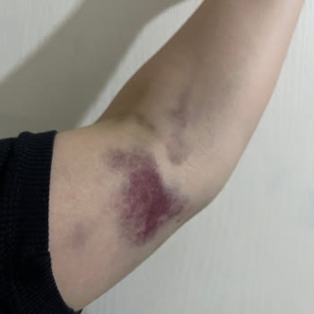 Palmiye Hastanesi Yanlış İğne Kullanımı Ve İlgisiz Hemşir Sorunu