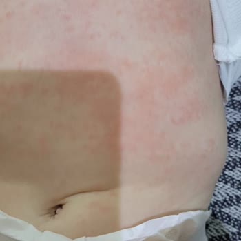 Mustela Stelatopia: Çocuğumuzda Kırmızı Benekler