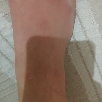 Ayak Maskesi Sonrası Kaşıntı Ve Kızarıklık Sorunu