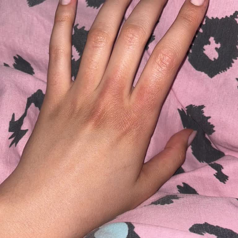 Sleepy Temizlik Mendili Egzama Sorunu