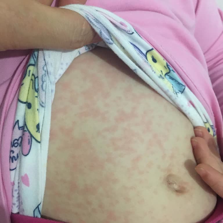 Klamoks İlacının Ciddi Yan Etkileri: Çocuğum Deneme Tahtası Mı?