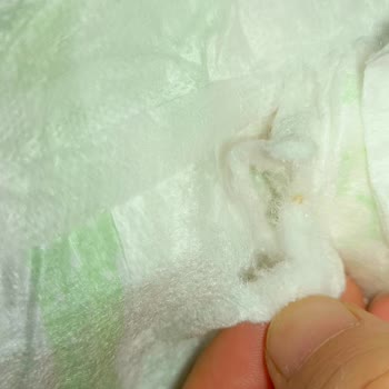 Bebek Bezlerinde Tekrarlayan Sertlik Sorunu