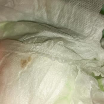 Bebek Bezlerinde Tekrarlayan Sertlik Sorunu