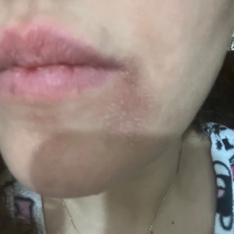 Cilt Bakımı Sonrası Hayal Kırıklığı