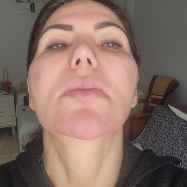 Çene Protezi Mağduriyeti: Kalıcı Hasar Bıraktı Op. Dr. Ayşen Bilge Sezgin Umursamadı!