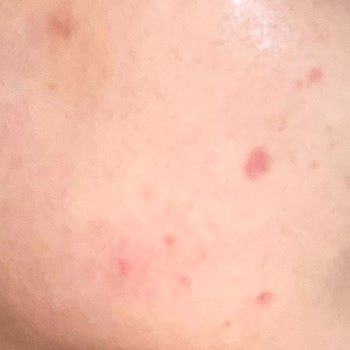 Cilt Bakımında Hayal Kırıklığı: Kalıcı Hasar Ve İzler