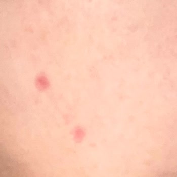 Cilt Bakımında Hayal Kırıklığı: Kalıcı Hasar Ve İzler