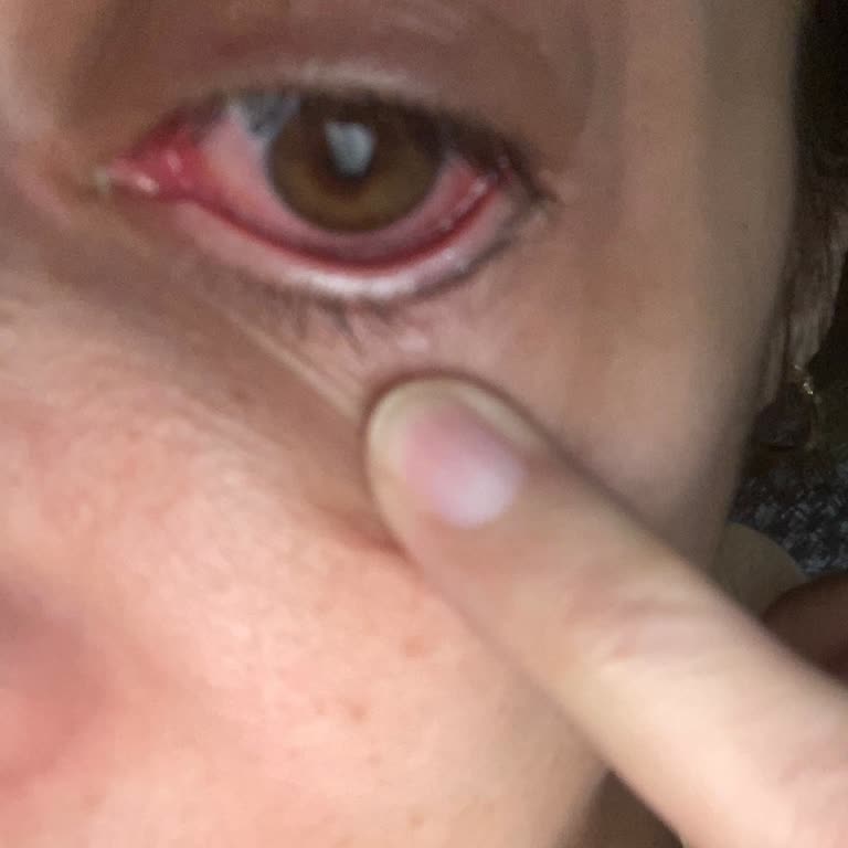 Göz Enfeksiyonuna Sebep Olan Maskara