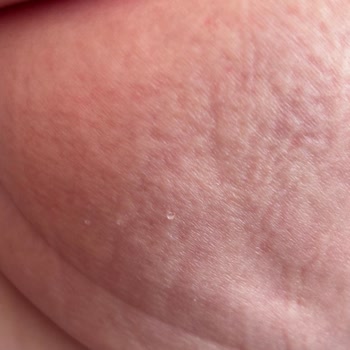 Bebek Bezinde Şeffaf Parçacık Şoku