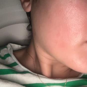 La Roche-Posay Toner Burned My Skin and Caused Redness—Not for Sensitive Skin