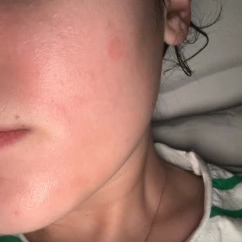 La Roche-Posay Toner Burned My Skin and Caused Redness—Not for Sensitive Skin