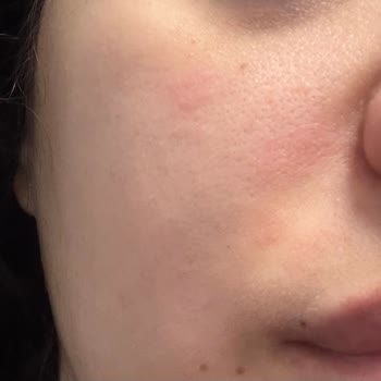 Cilt Ürünleri Egzama Ve Kaşıntıya Sebep Oldu