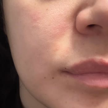 Cilt Ürünleri Egzama Ve Kaşıntıya Sebep Oldu