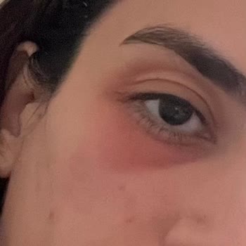 Altın İğne Uygulaması Sonrası Mağduriyet