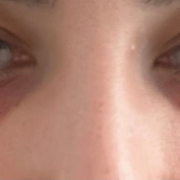Altın İğne Uygulaması Sonrası Mağduriyet